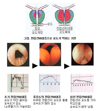 전립선2 전립선2