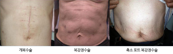 각 수술별 복부상처(이미지) 각 수술별 복부상처(이미지)