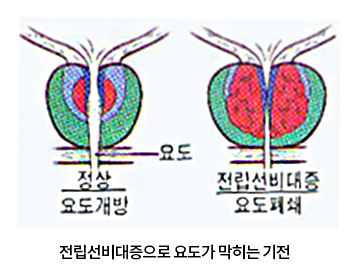 전립선비대증으로 욛도가 막히는 기전,