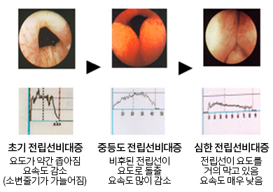 초기 전립선비대증(요도가 약간 좁하짐, 요속도 감소, 소변줄기가 가늘어짐), 중등도 전립선비대증(비후된 전립선이 요도로 돌출 요속도 많이 감소), 심한 전립선비대증(전립선이 요도를 거의 막고 있음 요속도 매우 낮음)