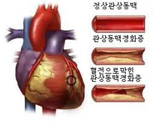 정상관상동맥, 관상동맥경화증, 혈전으로 막힌 관상동맥경화증