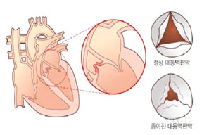 정상대동맥판막, 좁아진 대동맥판막