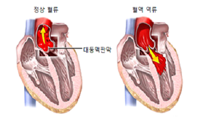 정상혈류 대동맥판막, 혈액 역류 대동맥판막