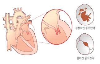 정상적인 승모판막, 좁아진 승모판막