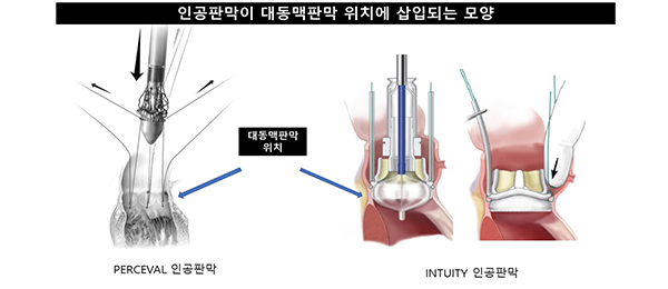 인공판막이 대동맥판막 위치에 삽입되는 모양, PERCEVAL인공판막, INTUITY 인공판막